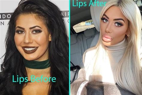 chloe ferry teeth